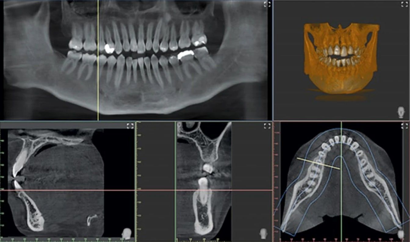 Écran du logiciel d’imagerie : radiographie panoramique, mâchoire reconstituée en trois dimensions et coupes de l’os.