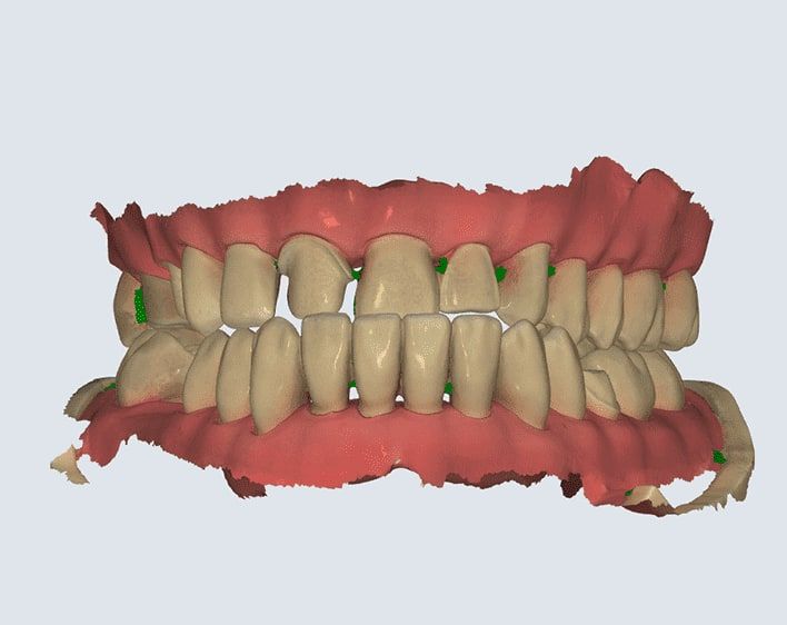 Modèle en trois dimensions des dents du haut et du bas, obtenu par empreinte numérique.