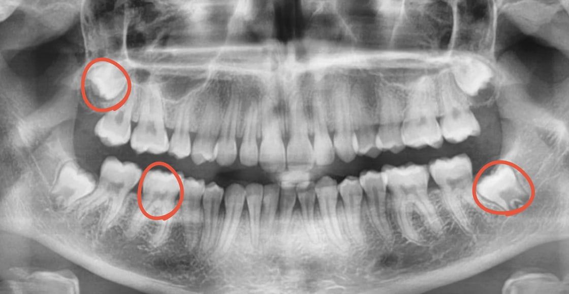 Radiographie panoramique en noir et blanc des deux mâchoires, sur laquelle trois dents sont entourées en rouge : les deux dents de sagesse visibles et une molaire du bas.